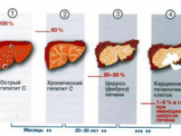 Гепатит С - факты о болезни