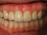 Имплантация зубов и противопоказания, которые можно обойти. Реально ли это?