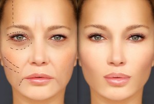 Mature woman-young woman.Endoscopic forehead and brow lift.Marking the face.Perforation lines on females face, plastic surgery concept.